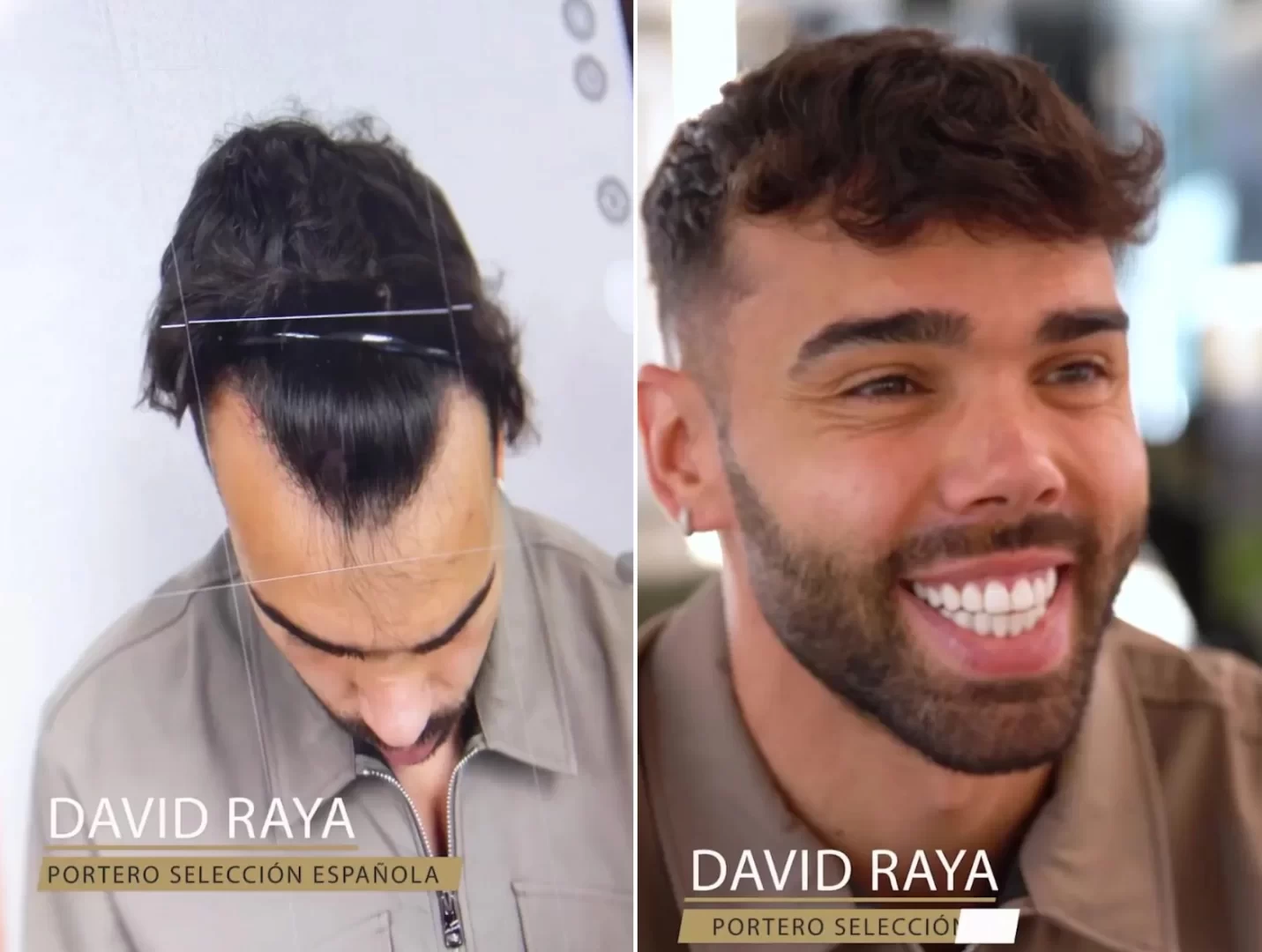 Arsenal goalkeeper Raya gets hair transplant, fans say “defence is about to change”